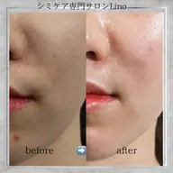 【韓国肌管理No.1】ララピール