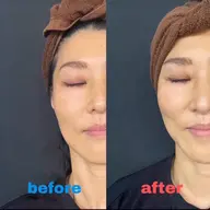 光フェイシャル