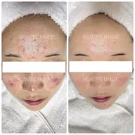 どうしたらニキビが治るのかわからない…自分では限界を感じている方👉150通りの施術からあなたに合わせた施術をご提供🌈