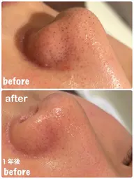 発光肌がかなう✨✨【全顔】毛穴洗浄😶‍🌫️×ビタミンC超音波導入🍋 口コミ価格🙇🏻‍♀️