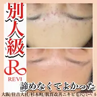 【初回】陶肌トリートメント(ハーブピーリング)ニキビ毛穴シミなど◎植物幹細胞配合ホームケア半額体験付