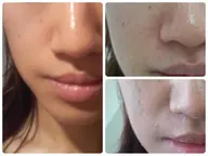 【ご新規様限定】いちご鼻卒業キュッと毛穴引き締め‼️