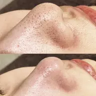 【全顔】すぐ予約限定　1度で実感‼️黒ずみ/毛穴