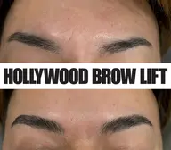 ハリウッドブロウリフト