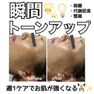 【肌質改善🫧】繰り返す肌トラブルを改善！気になる毛穴の汚れや角栓にも！美白透明感UP/剥離なしピーリング