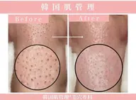 【くすみ一掃×水光肌チャージ✨疲れ顔リセットコース】光フェイシャル+韓国式毛穴ケア