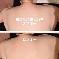 肩こりにキャビテーション