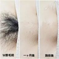 【1番人気🌟】VIOダブル脱毛🍋シュガーリング×最新光脱毛