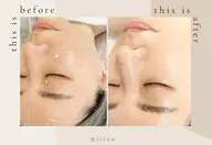 人気No.1🎖️✨韓国艶肌🇰🇷毛穴撲滅‼️肌のキメを整えるピーリング🫧