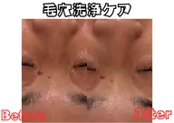 【5名限定！！】毛穴掃除付き！フェイシャルエステ♡