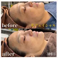 【男女】光フェイシャル(照射のみ)初回キャンペーン