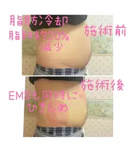 冷却スリミングケア4部位