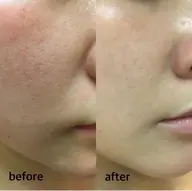 《毛穴引き締めツヤ肌コース》