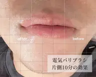 電気バリブラシ