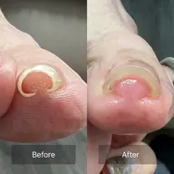 巻き爪補正🦶モニター価格❣️