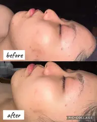 レディースシェービング（パック付き）