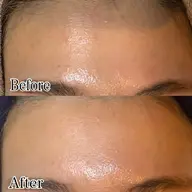 フェイシャルWax脱毛