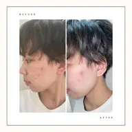 繰り返すニキビに🌿肌質改善フェイシャル