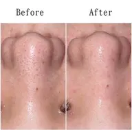 【🎀初回限定🎀】ハイドロ毛穴洗浄✨️黒ずみ除去＆つるん肌体験