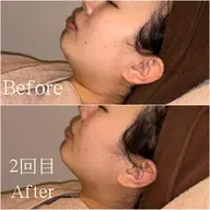 人気No.1！【小顔脂肪ぶんかいケア☆】気になる二重あごやフェイスラインをスッキリ改善✨