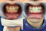 🉐歯科提携サロン🦷💎【歯科レベルの効果】ハイパー照射機使用❣️高性能ホワイトニング8分×4回照射🌈