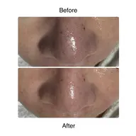 【鼻の黒ずみ・ザラつき】毛穴詰まり集中ケア|1回で触って変化◎