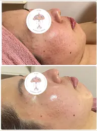 【ニキビ悩み】ハーブピーリング