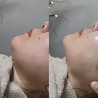 "艶"爆誕ガラス肌コース