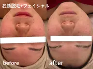 美肌顔脱毛（シェービング付き）+毛穴ケア+美白フェイシャルパック¥11,000▶︎２回¥13,000円