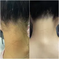 【イベント前の駆け込み歓迎！】うなじ美肌ケア✨シェービング付き◎