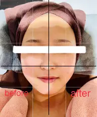 小顔美肌コース🎀サーマルFR+美肌パック+肌再生クリーム＋デコルテ～頭マッサージ付き🎀