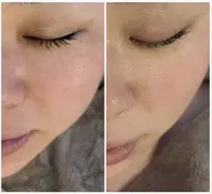 【花粉による肌荒れ・乾燥・敏感】お肌に優しい角質ケア🤍肌表面を潤いたっぷりのお肌へ🫧