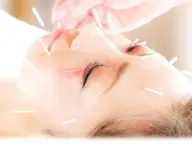 ✨✨美容鍼 ✨ ✨