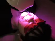 【ホワイトニング】高濃度ジェル使用