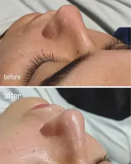 毛穴吸引洗浄(クレンジング・角質溶解パック・毛穴吸引洗浄・鎮静モデリングパック)