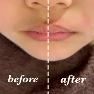 キッズ脱毛👧🏻👦🏻鼻下シュガーリング脱毛🐝🍯