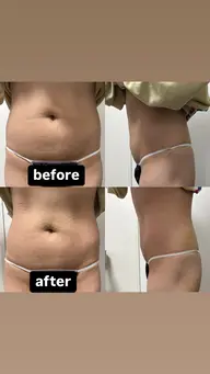 お腹3カップ🌼お腹気になる方！1度でお腹の脂肪サヨナラ💥👋