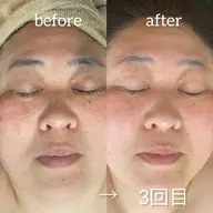 【光フェイシャル】お悩み別照射（シミ/赤ら顔,ニキビ/しわ,たるみの３種類の光をご用意）➕鎮静。