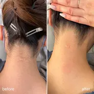 wax脱毛【うなじ】