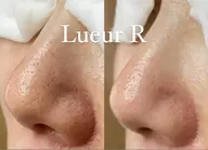 ♦︎毛穴ケアコース♦︎何を使っても何をしても変わらなかった頑固な毛穴　オールハンドの毛穴エクストラクションプロ