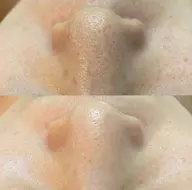 【毛穴・黒ずみケアに◎】REVIハーブピーリング