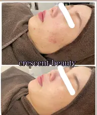 写真モニター価格💎ニキビ、肌荒れを繰り返さない肌に🫧国産高級ハーブピーリング🌿¥22000→¥7700