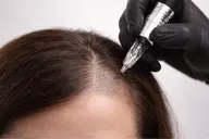 【頭皮密度デザイン】生え際・頭頂部の透け感を２週間で改善🔥 5cm×5cm体験プラン