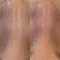 【4月先着10名様まで※残り5名様】どこでも1箇所お試しエクストラクション¥5500