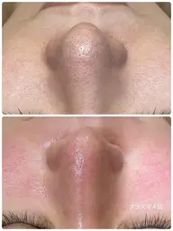 ✨人気No１✨肌質ケア顔脱毛【毛穴×ニキビ×乾燥×シミ×しわ×たるみ×くすみ×赤み】結果重視脱毛✨