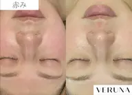 ハーブピーリング剥離なし〈オーダーメイド調合施術〉