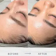 【牛田店限定】高速美肌脱毛⭐︎痛みもなく、スピード脱毛を実現！顔全体+Sランクヒト幹細胞培養液お仕上げ付き