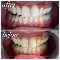 🏫セルフホワイトニング🏫学割‼️初回体験10分×3回　​〜​安心のカウンセリング付き​〜​