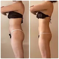 🎀大人気🎀キャビリポDEX-V脂肪にアプローチ💥キャビテーション・吸引W痩身★選べる4部位90分