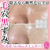 毛穴フェイシャル